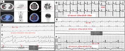 Overdrive pacing in the acute management of osimertinib-induced ventricular arrhythmias: A case report and literature review